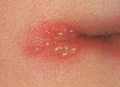 Illustration for article titled obat herpes di bibir